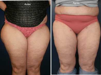 lipo aspiration 1